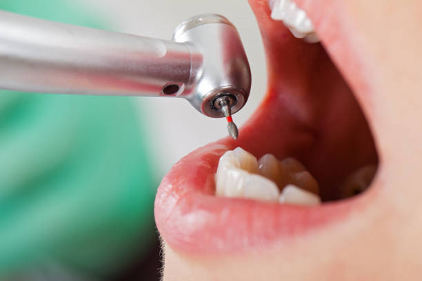 Best Emergency Dental Care for Broken or Chipped Teeth in Chillum, MD
